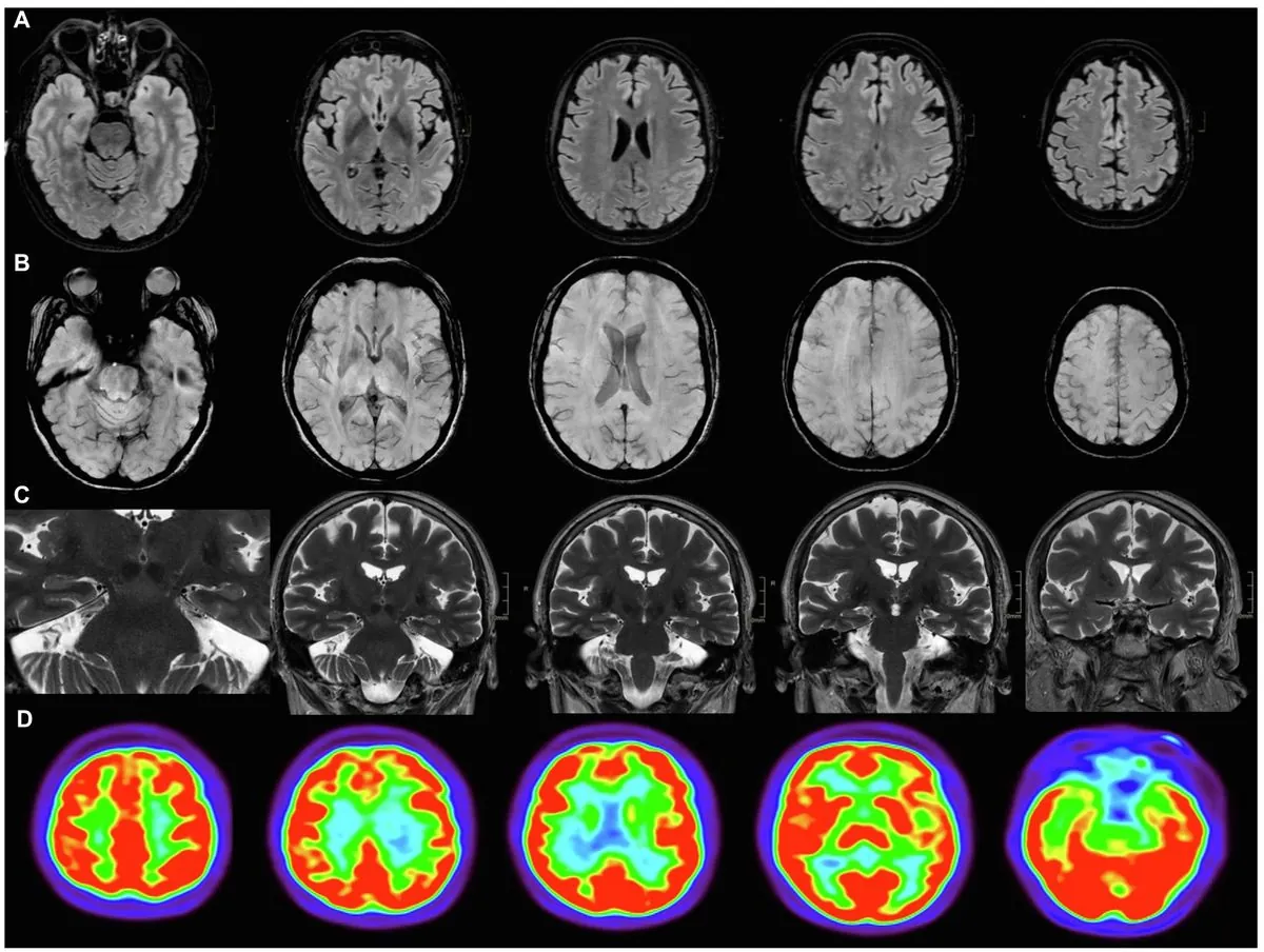 Covid-19 : Des déficits cognitifs persistants même après une infection légère